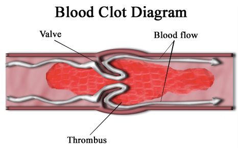 Covisheild can cause cloting of blood